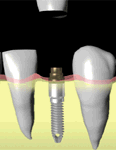  Экспресс имплантация зубов